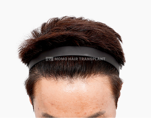 남성 절개 모발이식 after