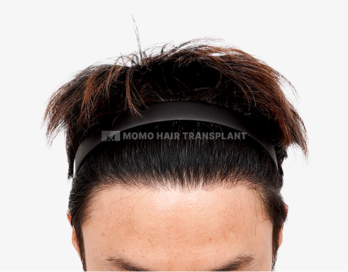 남성 절개 모발이식 after