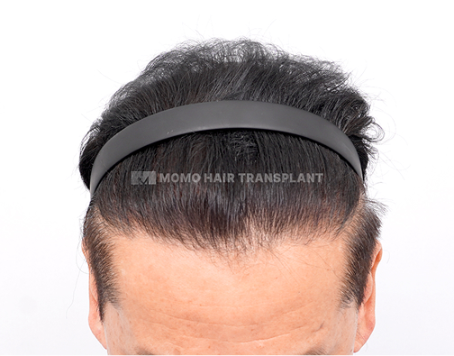 남성 절개 모발이식 after