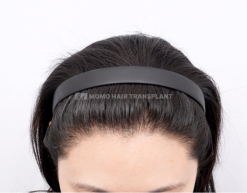 여성 절개 모발이식 after