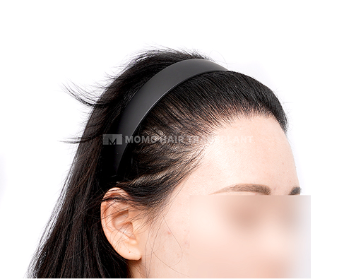 여성 절개 모발이식 after