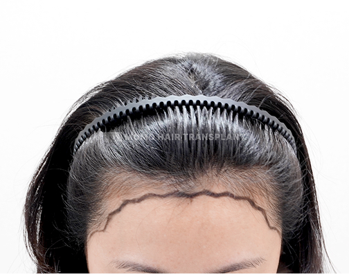 여성 절개 모발이식 before