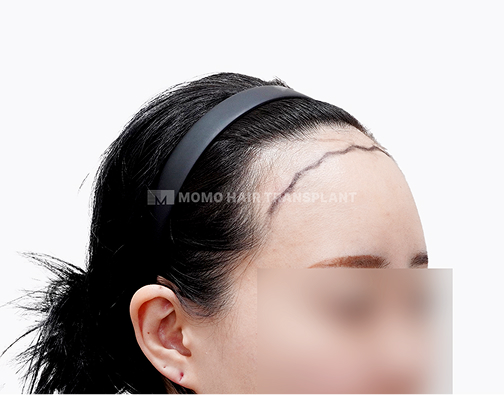 여성 절개 모발이식 before