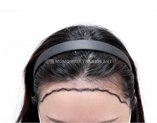 여성 절개 모발이식 before