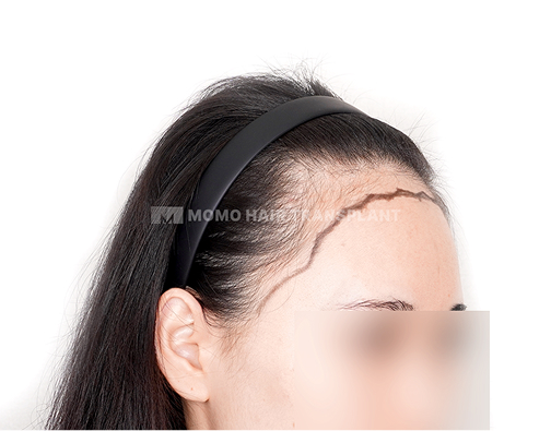 여성 절개 모발이식 before