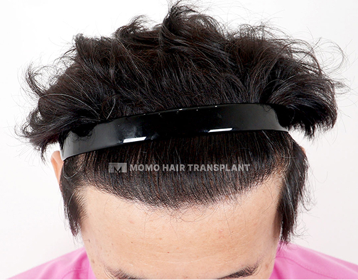남성 비절개 모발이식 after