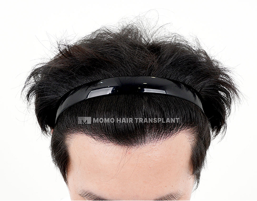 남성 비절개 모발이식 after