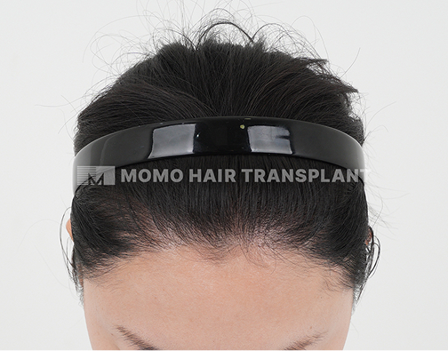 여성 비절개 모발이식 after