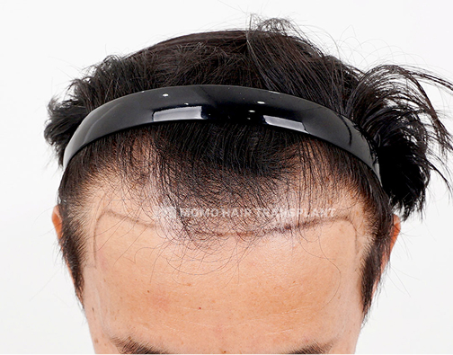 남성 비절개 모발이식 before