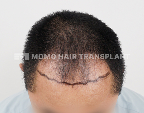 남성 비절개 모발이식 before