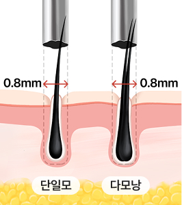 건강한 모발 선별 채취
