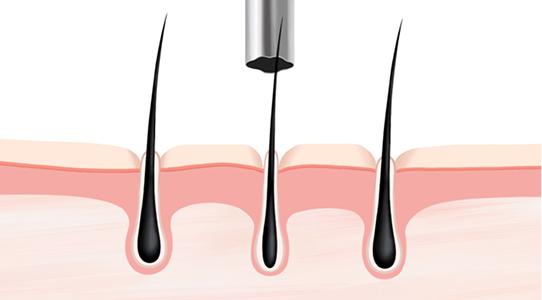 연모화 모발 채취