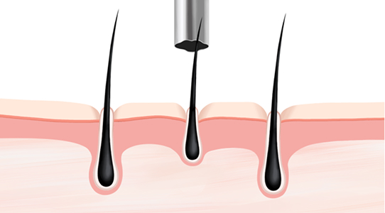 얕은 모발 채취