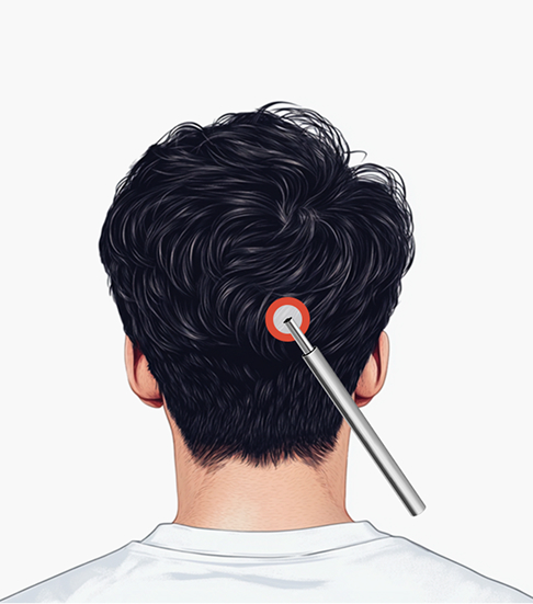 절개 모발이식 수술방법