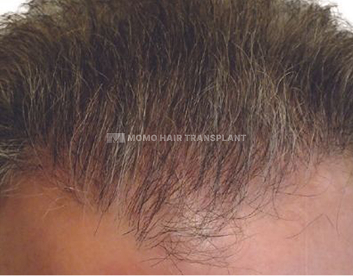 아타스iX 모발이식 after