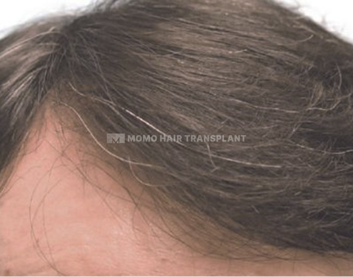 아타스iX 모발이식 after