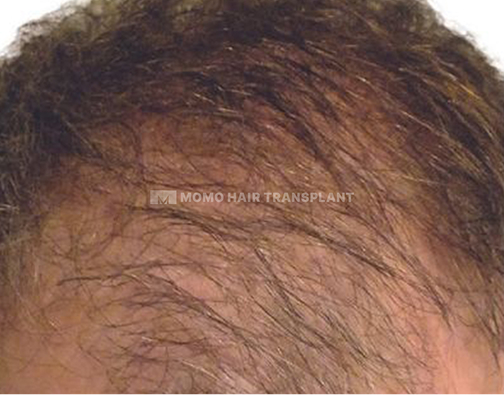 아타스iX 모발이식 before