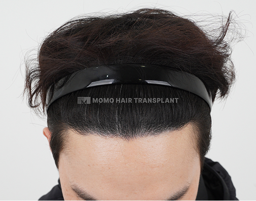 남성 비절개 모발이식 after