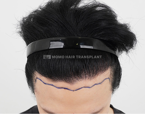 남성 비절개 모발이식 before