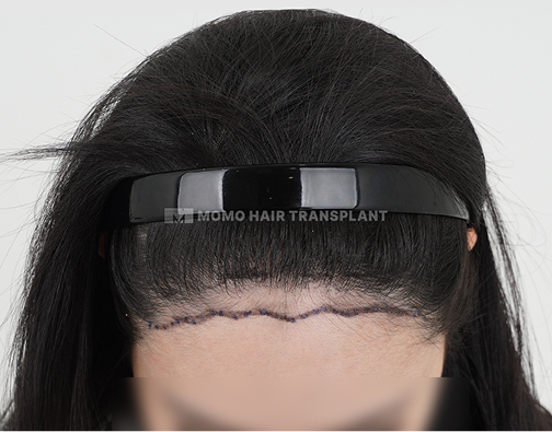 남성 비절개 모발이식 before