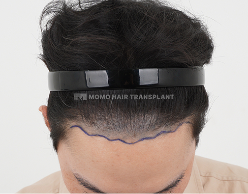 남성 비절개 모발이식 before