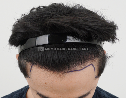남성 비절개 모발이식 before