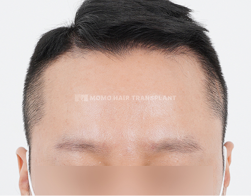 눈썹 모발이식 before