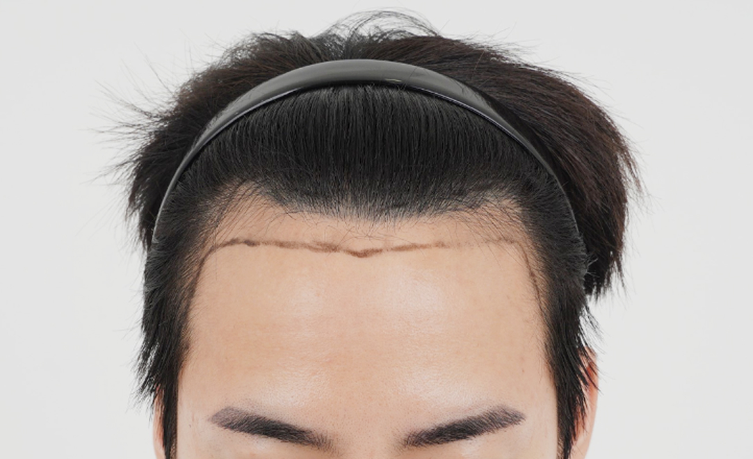 이마라인 디자인