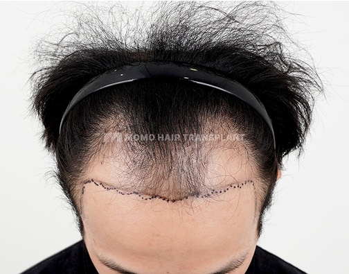 남성 혼용 모발이식 before