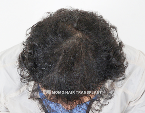 남성 정수리 모발이식 after