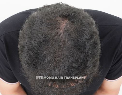 남성 정수리 모발이식 after