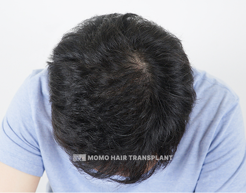 남성 정수리 모발이식 after