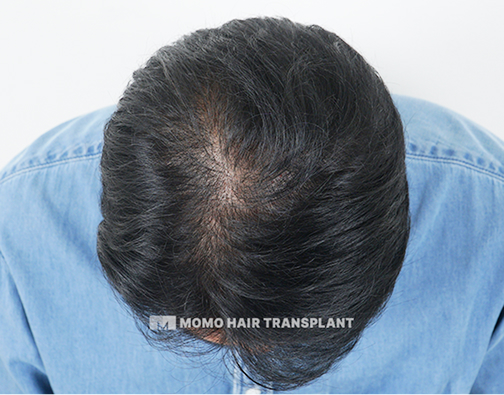 남성 정수리 모발이식 after