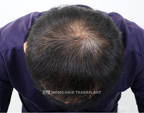남성 정수리 모발이식 after