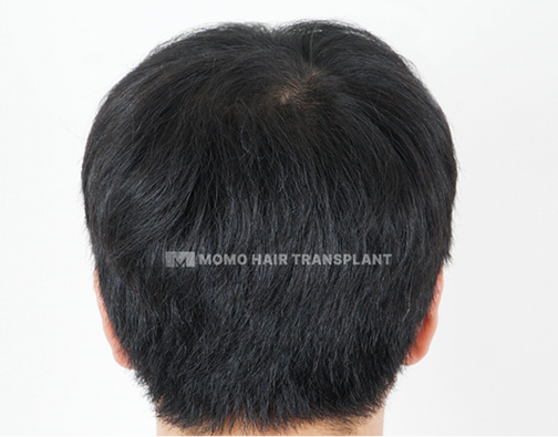 남성 정수리 모발이식 after