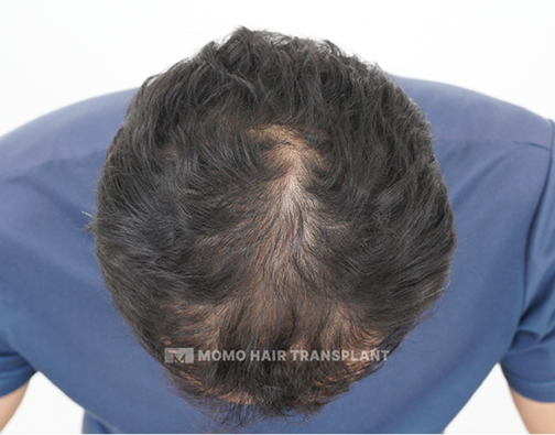 남성 정수리 모발이식 before