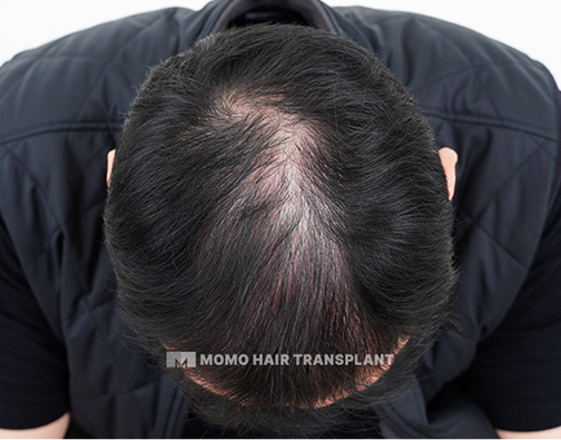 남성 정수리 모발이식 before