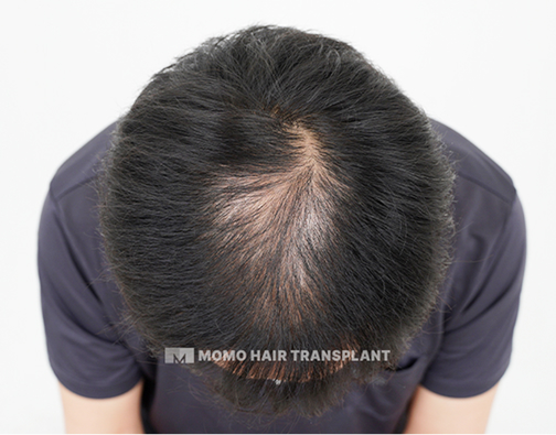 남성 정수리 모발이식 before