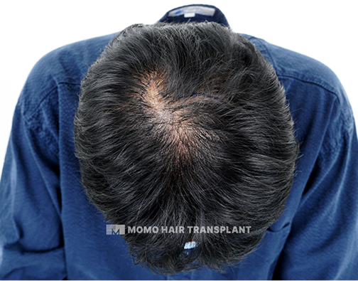 남성 정수리 모발이식 before