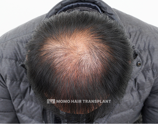 남성 정수리 모발이식 before