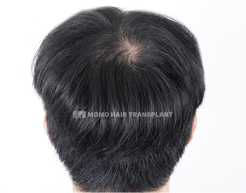 남성 정수리 모발이식 before