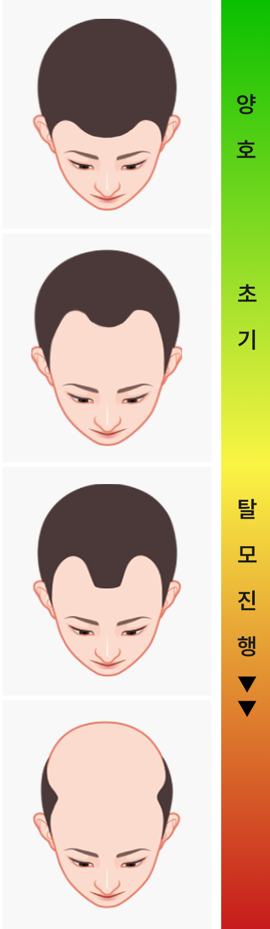 M자형 탈모 단계