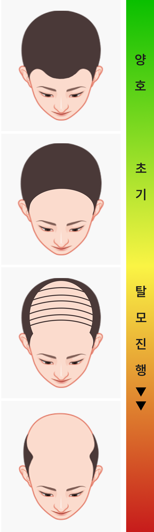 U자형 탈모 단계