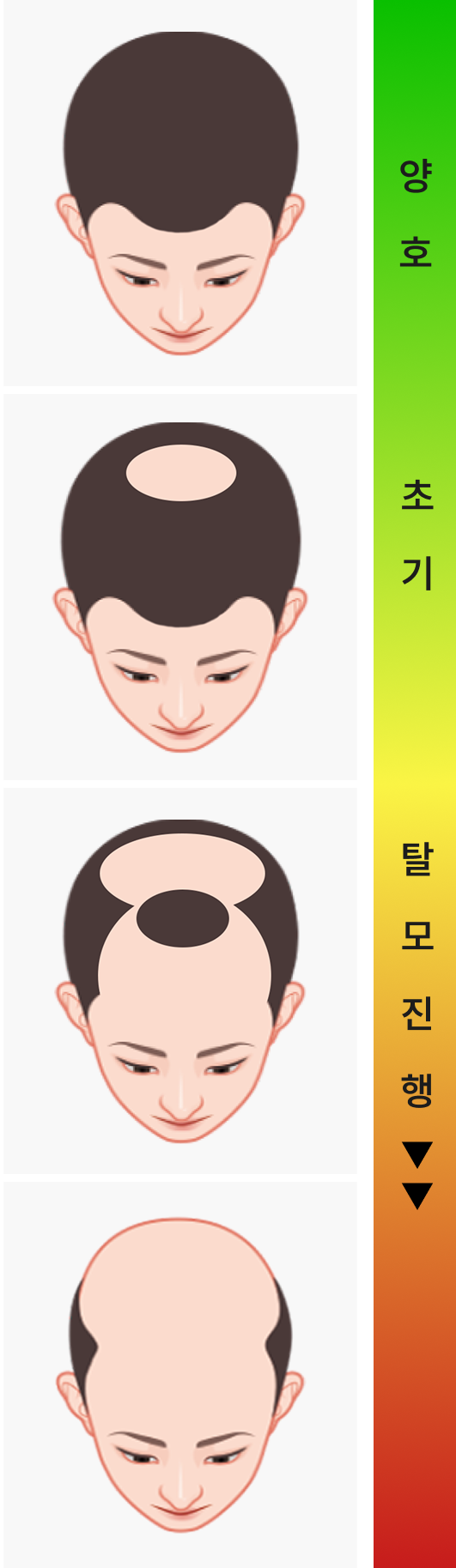 복합형 탈모 단계