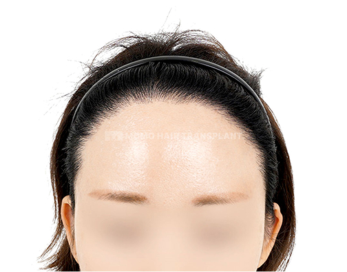 넓은이마 이마절개 모발이식 after