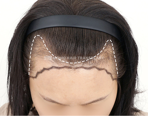 M자형 이마 절개 모발이식 before