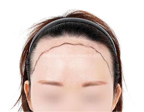 넓은이마 이마절개 모발이식 before