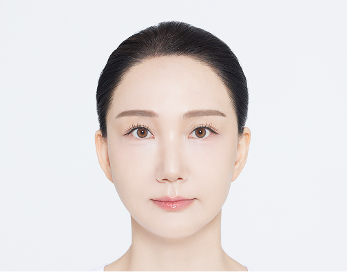 비절개 모발이식 after