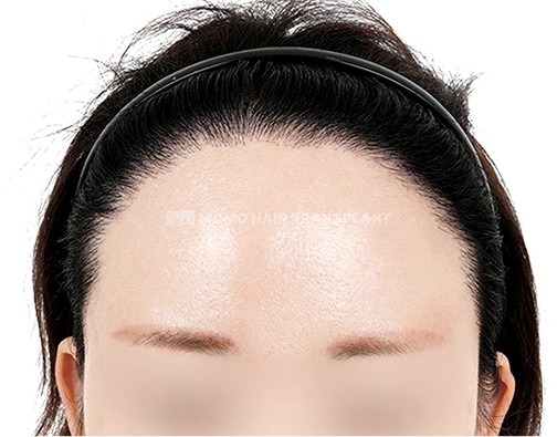 이마축소 흉터커버 절개 모발이식 after