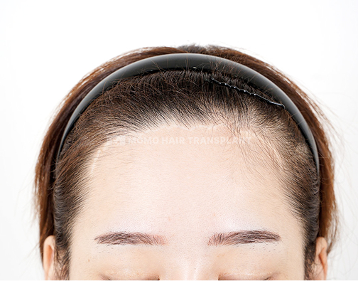 이마거상 흉터커버 비절개 모발이식 before